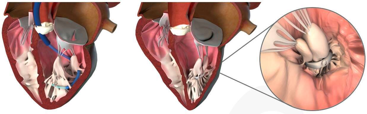 Cardiac Success Device